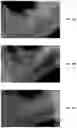 Fig. 48 - Endodontic instruments and root canal treatment methods