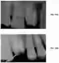 Fig. 49 - Endodontic instruments and root canal treatment methods