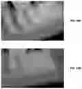 Fig. 50 - Endodontic instruments and root canal treatment methods