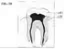 Fig. 03 - Root canal treatment apparatus