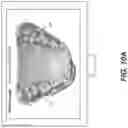 Fig. 11 - Method for virtual setup with mixed dentition