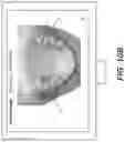Fig. 12 - Method for virtual setup with mixed dentition