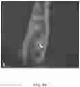 Fig. 06 - Surgical device and methods of use