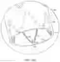 Fig. 15 - Vascular repair devices and methods of use