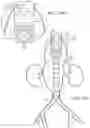 Fig. 17 - Vascular repair devices and methods of use