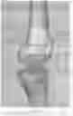 Fig. 07 - Systems and methods for attaching soft tissue to an implant