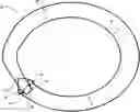 Fig. 01 - Corneal prosthesis and method of penetrating keratoplasty