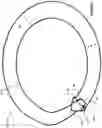 Fig. 03 - Corneal prosthesis and method of penetrating keratoplasty