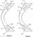 Fig. 09 - Corneal prosthesis and method of penetrating keratoplasty