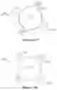 Fig. 14 - Two-part accommodating intraocular lens device