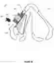 Fig. 06 - METHODS AND APPARATUS FOR TREATING GLOTTIC INSUFFICIENCY