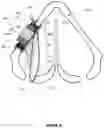 Fig. 07 - METHODS AND APPARATUS FOR TREATING GLOTTIC INSUFFICIENCY
