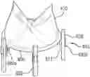 Fig. 01 - Modular percutaneous valve structure and delivery method
