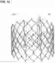 Fig. 18 - Modular percutaneous valve structure and delivery method