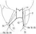 Fig. 01 - Heart valve with chordal capture elements for stabilization