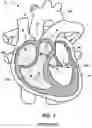 Fig. 02 - Heart valve with chordal capture elements for stabilization