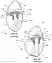 Fig. 03 - Heart valve with chordal capture elements for stabilization