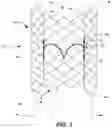 Fig. 04 - Heart valve with chordal capture elements for stabilization