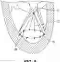 Fig. 07 - Heart valve with chordal capture elements for stabilization