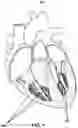 Fig. 02 - Device for transcatheterly delivering a band around papillary muscles