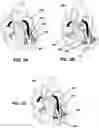 Fig. 03 - Device for transcatheterly delivering a band around papillary muscles