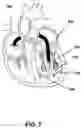 Fig. 08 - Device for transcatheterly delivering a band around papillary muscles