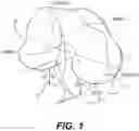 Fig. 02 - TOTAL ANKLE REPLACEMENT WITH ANATOMICALLY FITTED TALAR COMPONENT