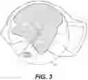 Fig. 04 - TOTAL ANKLE REPLACEMENT WITH ANATOMICALLY FITTED TALAR COMPONENT