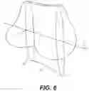 Fig. 08 - TOTAL ANKLE REPLACEMENT WITH ANATOMICALLY FITTED TALAR COMPONENT