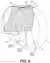 Fig. 10 - TOTAL ANKLE REPLACEMENT WITH ANATOMICALLY FITTED TALAR COMPONENT