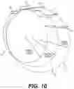 Fig. 11 - TOTAL ANKLE REPLACEMENT WITH ANATOMICALLY FITTED TALAR COMPONENT