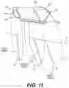 Fig. 12 - TOTAL ANKLE REPLACEMENT WITH ANATOMICALLY FITTED TALAR COMPONENT