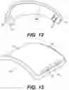 Fig. 13 - TOTAL ANKLE REPLACEMENT WITH ANATOMICALLY FITTED TALAR COMPONENT