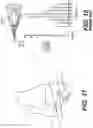 Fig. 16 - TOTAL ANKLE REPLACEMENT WITH ANATOMICALLY FITTED TALAR COMPONENT
