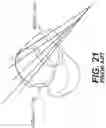 Fig. 18 - TOTAL ANKLE REPLACEMENT WITH ANATOMICALLY FITTED TALAR COMPONENT