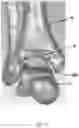 Fig. 20 - TOTAL ANKLE REPLACEMENT WITH ANATOMICALLY FITTED TALAR COMPONENT