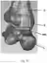 Fig. 21 - TOTAL ANKLE REPLACEMENT WITH ANATOMICALLY FITTED TALAR COMPONENT