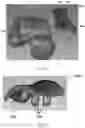 Fig. 22 - TOTAL ANKLE REPLACEMENT WITH ANATOMICALLY FITTED TALAR COMPONENT