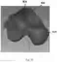 Fig. 25 - TOTAL ANKLE REPLACEMENT WITH ANATOMICALLY FITTED TALAR COMPONENT