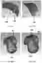 Fig. 26 - TOTAL ANKLE REPLACEMENT WITH ANATOMICALLY FITTED TALAR COMPONENT