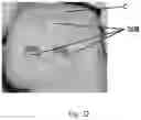 Fig. 28 - TOTAL ANKLE REPLACEMENT WITH ANATOMICALLY FITTED TALAR COMPONENT