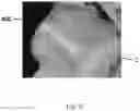 Fig. 29 - TOTAL ANKLE REPLACEMENT WITH ANATOMICALLY FITTED TALAR COMPONENT