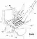 Fig. 11 - Surgical method and instrumentation assembly for positioning an ankle prosthesis