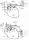 Fig. 14 - Method and instrument for treating obesity