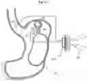 Fig. 15 - Method and instrument for treating obesity
