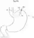 Fig. 26 - Method and instrument for treating obesity