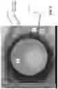 Fig. 03 - SYSTEMS AND METHODS TREATING FOR CORNEAL ECTATIC DISORDERS