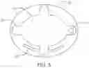Fig. 04 - INTRASCLERAL DRUG DELIVERY DEVICE AND ASSOCIATED METHODS