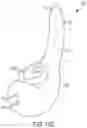 Fig. 31 - Pressure field stimulation device having adaptable arm