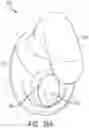 Fig. 47 - Pressure field stimulation device having adaptable arm